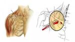 متلازمة مخرج الصدر Thoracic Outlet Syndrome