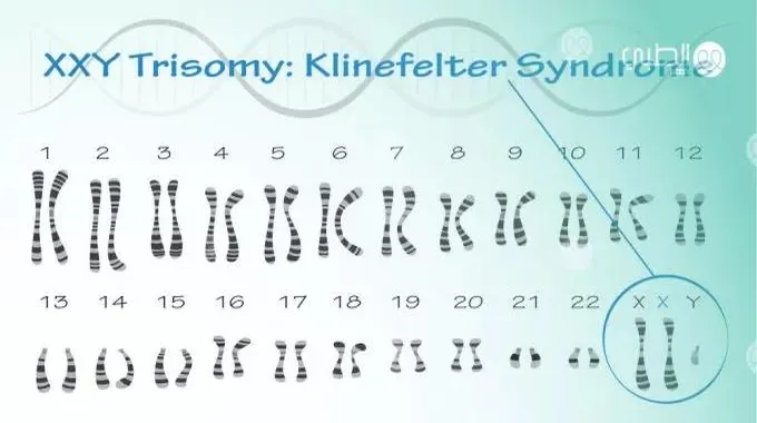 متلازمة كلاينفلتر.. الأعراض والمخاطر