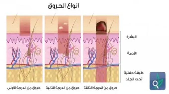 الآلام الناجمة عن تعرض الجلد إلى الحروق وطرق