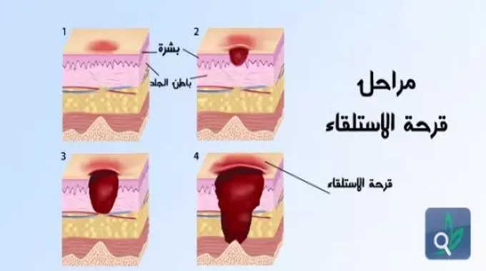 قرحة الاستلقاء وعلاجها