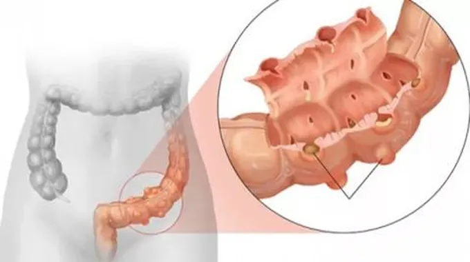 داء الرتوج في القولون (Diverticulitis)