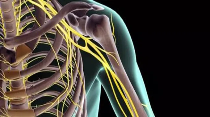 إصابة الضفيرة العصبية العضدية عند حديثي