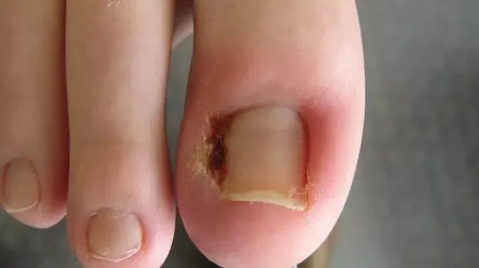 نمو أظفر إصبع القدم للداخل (Ingrown Toenail)