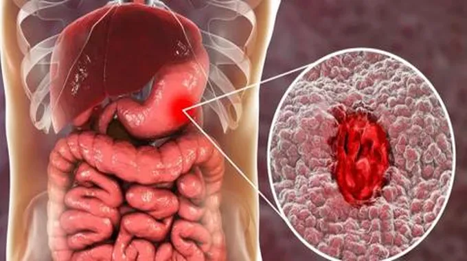 أخطاء تؤدي إلى قرحة المعدة وطرق طبيعية لعلاجها