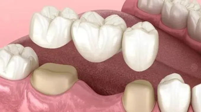 جسور الأسنان: كل ما تريد معرفته عنها
